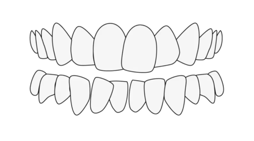 Affollamento dentale